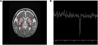 Case Report: A Novel Intronic Mutation in AIFM1 Associated With Fatal Encephalomyopathy and Mitochondrial Disease in Infant